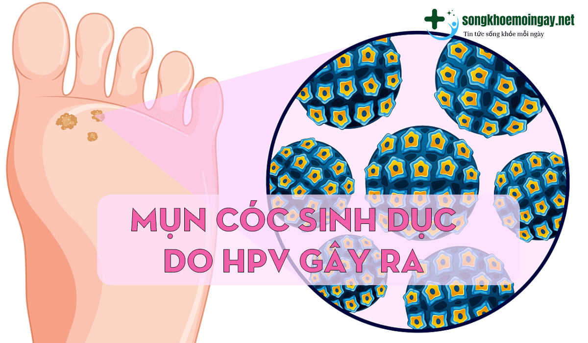 Mụn cóc sinh dục do HPV gây ra